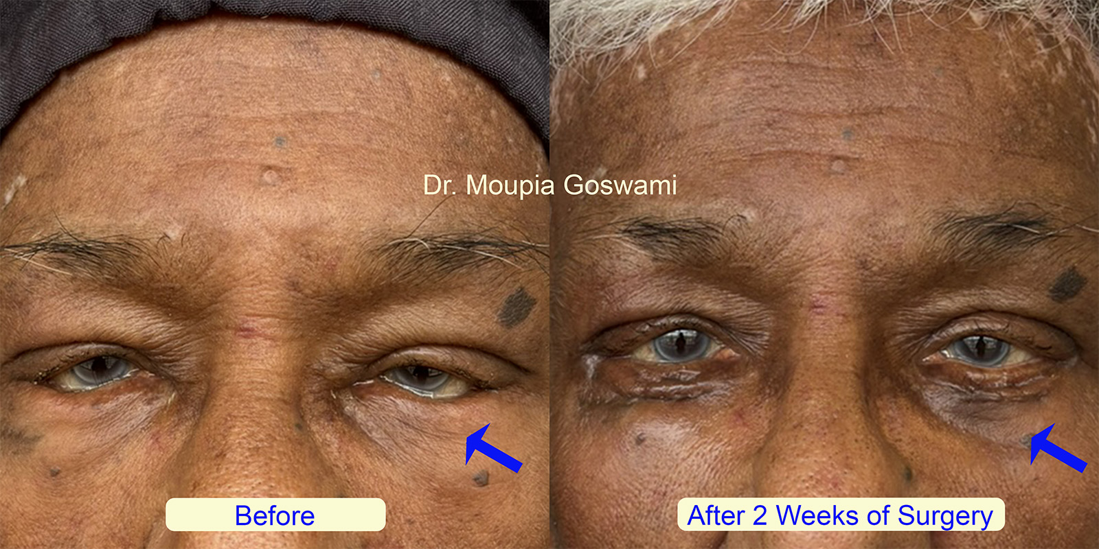 Before and After Entropion Surgery Result - Case 6